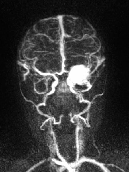 MR angiography: infantile hemangioma on the eyelid