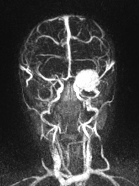 MR angiography: infantile hemangioma on the eyelid