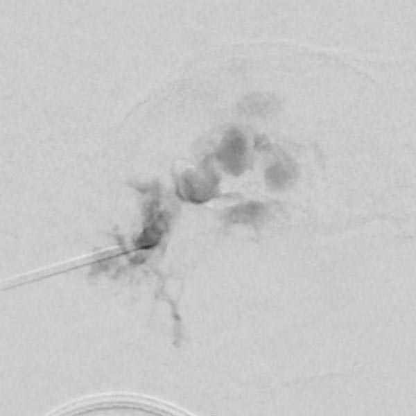 DSA with venous drainage is depicted