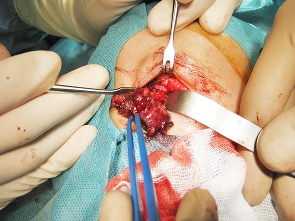 Intraoperative site