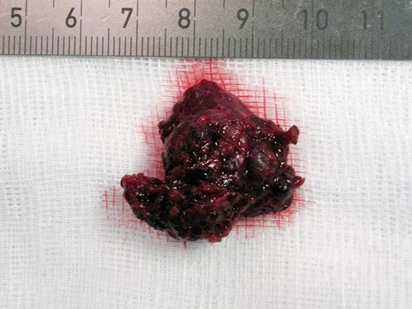 Resection specimen of the infantile hemangioma