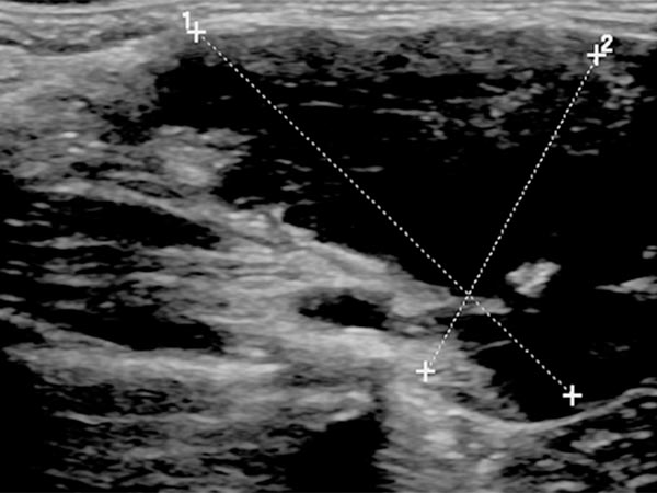 Sonography: venous malformation