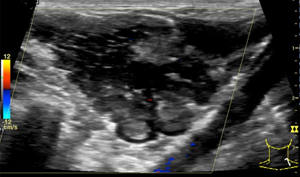 color-coded duplex sonography: venous malformation