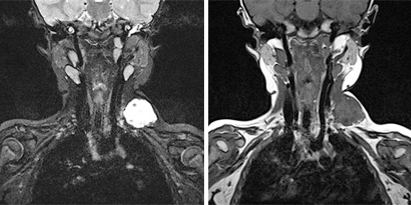 MRI: venous malformation