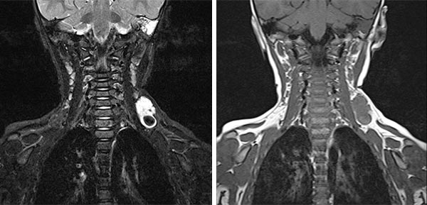 MRI: thrombus within the venous malformation