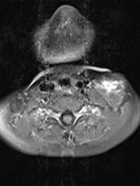 MRI: venous malformation