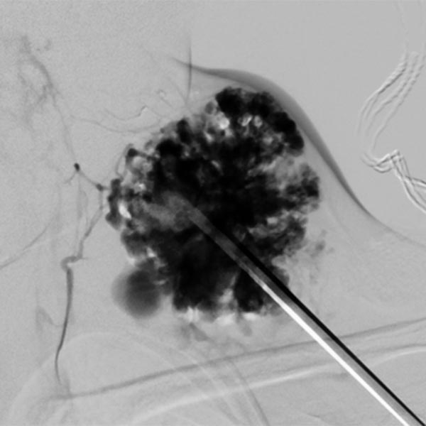 DSA: venous malformation