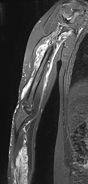 MRI: slow-flow malformation