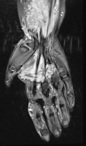 MRI: venous malformation