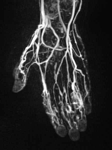 MR angiography: venous malformation