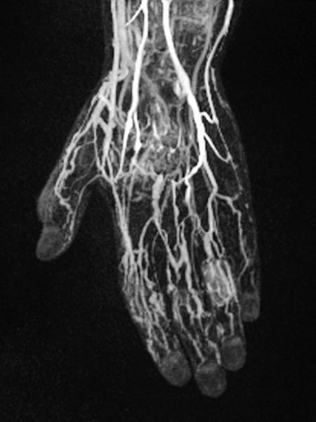 MR angiography: venous malformation