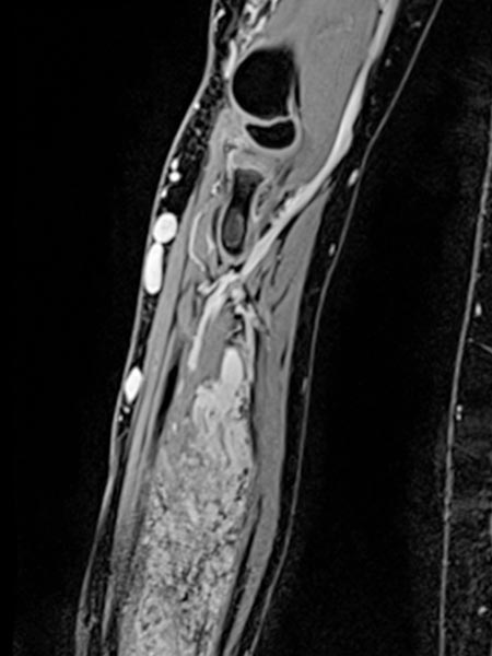 MRI: venous malformation