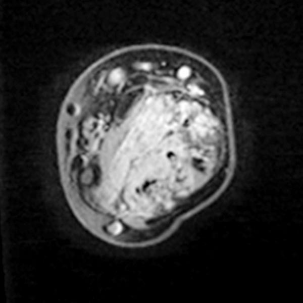 MRI: venous malformation