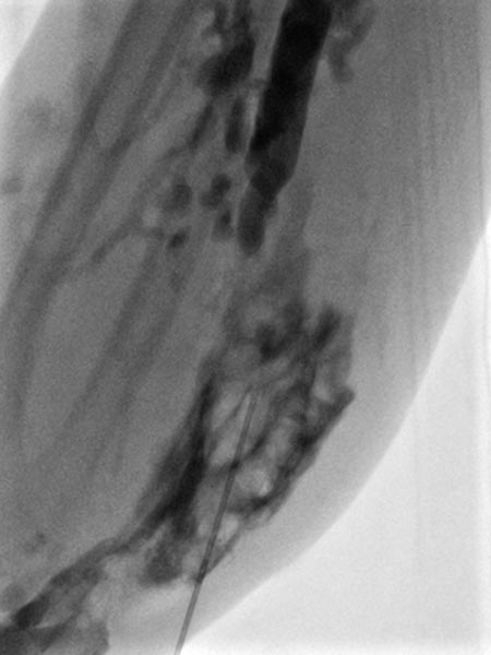 Sclerosing: venous malformation