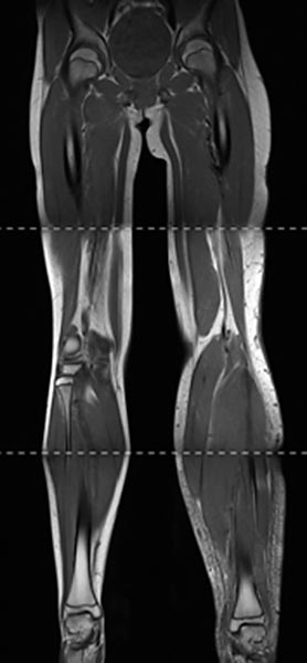 MRI: Parkes-Weber syndrome