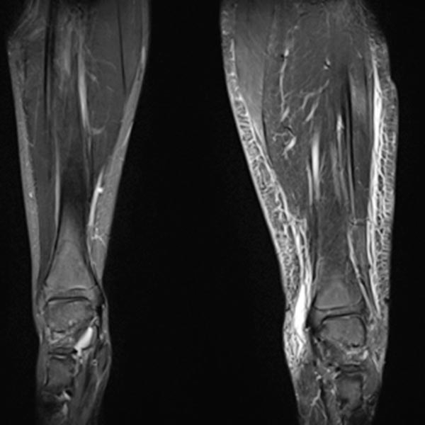 MRI: Parkes Weber syndrome