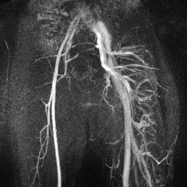 MR-Angiography: Parkes Weber syndrome