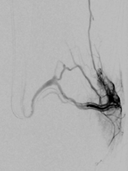 Digital subtraction angiography: Parkes Weber syndrome