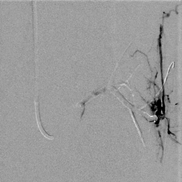 Embolization: Parkes Weber syndrome