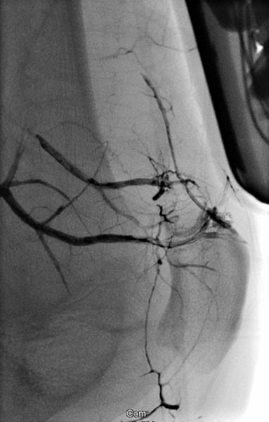 Embolization: Parkes Weber syndrome