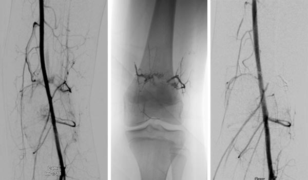 DSA: after embolization