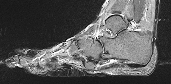 MRI: cerebriform mixed connective tissue nevus