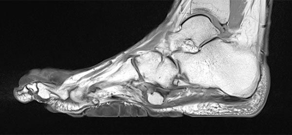 MRI: cerebriform mixed connective tissue nevus