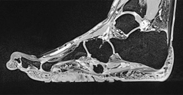MRI: cerebriform mixed connective tissue nevus