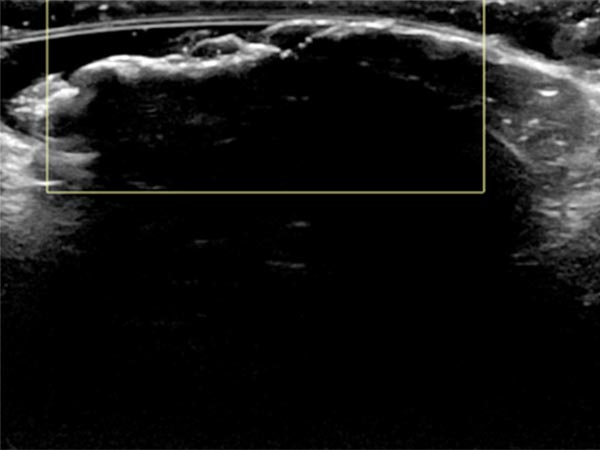 Color-coded duplex sonography: no perfusion detectable