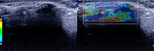 Ultrasound elastography: connective tissue nevus