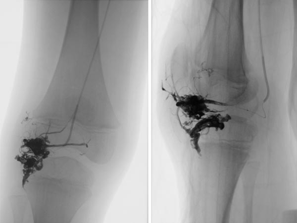 X-ray: after successful embolization