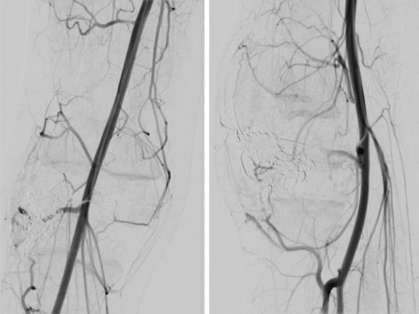 DSA: after embolization with ethylene-vinyl alcohol copolymer