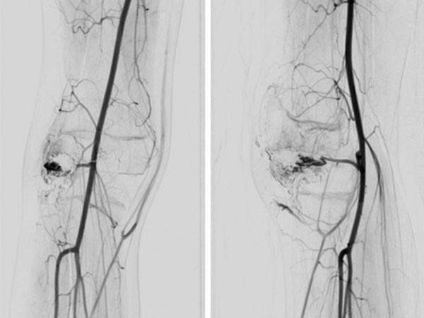 DSA: after embolization with ethylene-vinyl alcohol copolymer