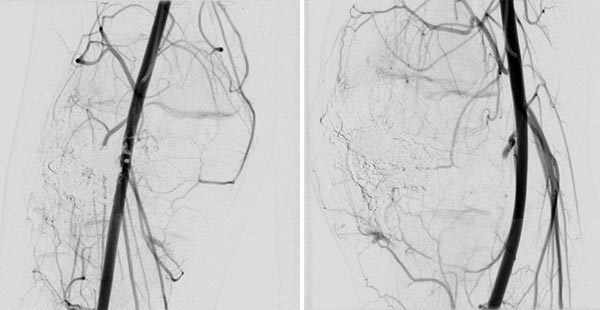 DSA: after completion of repeat embolization