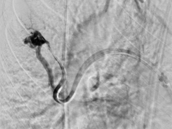 Digital subtraction angiography: pulmonary AVM in the upper lobe