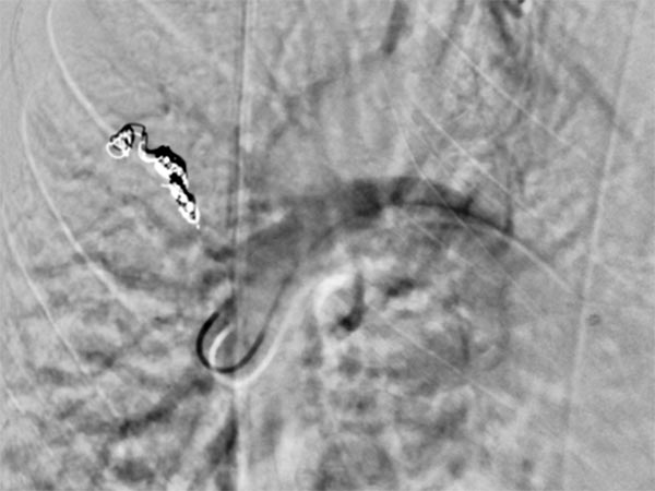 Digital subtraction angiography: pulmonary AVM in the upper lobe