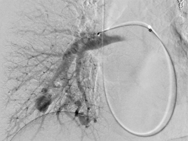 Digital subtraction angiography: pulmonary AVM in the lower lobe