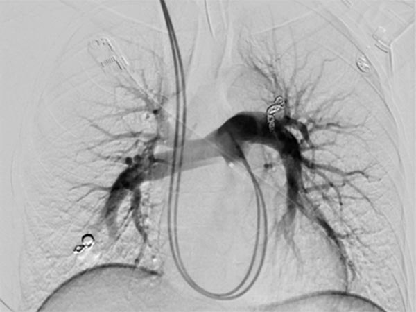 Digital subtraction angiography: no more flow into the pulmonary AVMs
