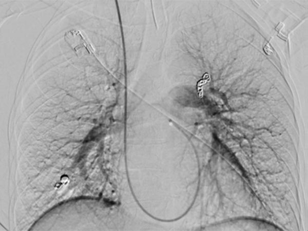 Digital subtraction angiography: complete occlusion of the pulmonary AVMs