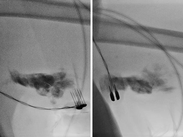 Fluoroscopy during electrosclerotherapy