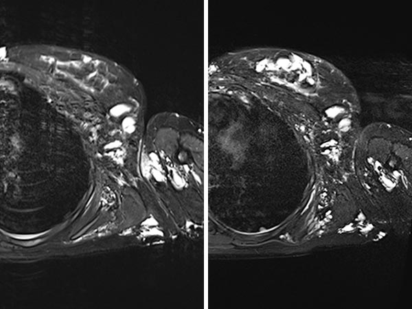 MRI: before and after bleomycin electrosclerotherapy