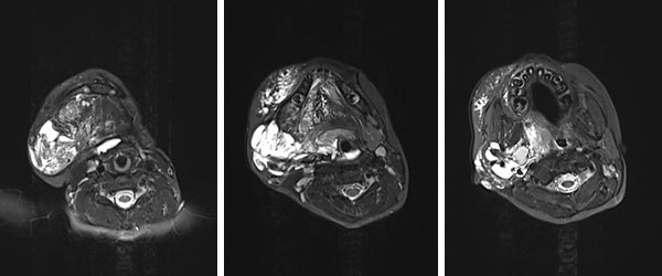 MRI: lymphatic malformation