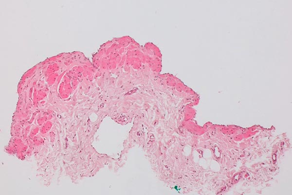 Biopsy specimen – Combined venolymphatic malformation