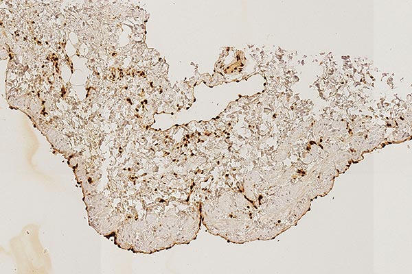 Immunohistochemical staining – Combined venolymphatic malformation