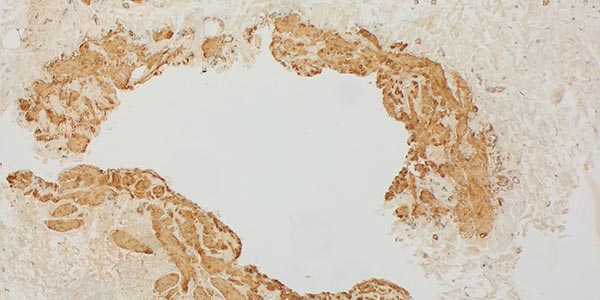 SMA staining – Combined venolymphatic malformation