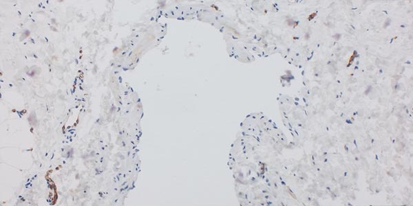 WT1-staining – Combined venolymphatic malformation