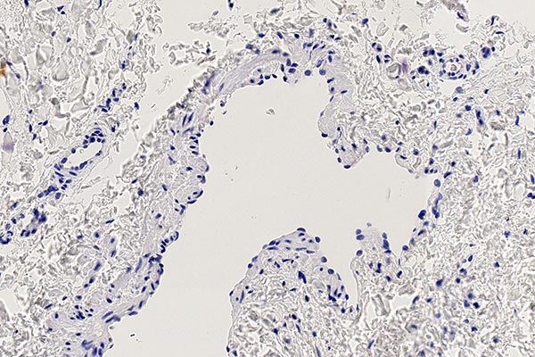 Ki67-staining – Combined venolymphatic malformation