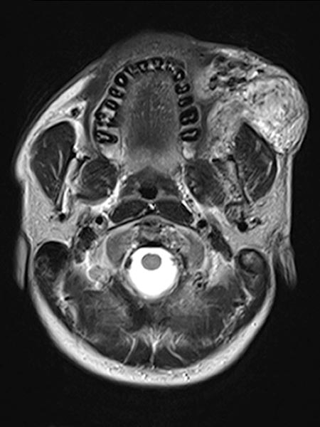 MRI: arteriovenous malformation