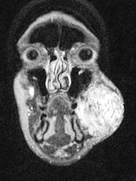 MRI: arteriovenous malformation