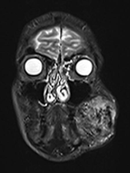 MRI: arteriovenous malformation